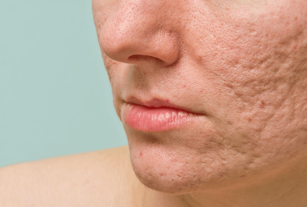 Acne Scars | JPP Skin Laser Clinic
