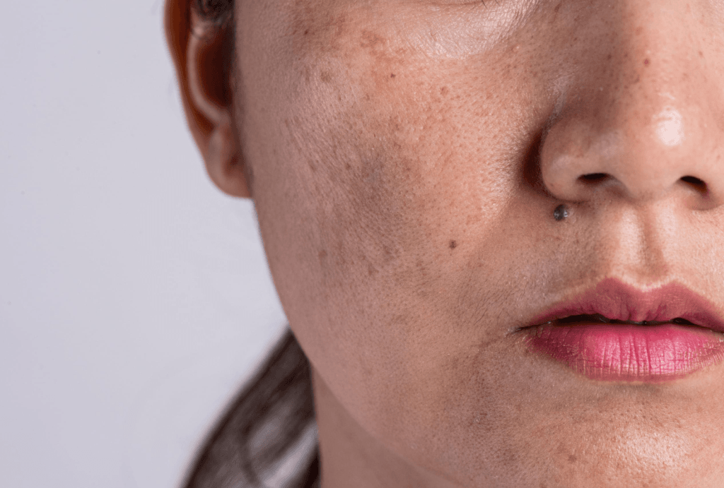 Melasma | JPP Skin Laser Clinic
