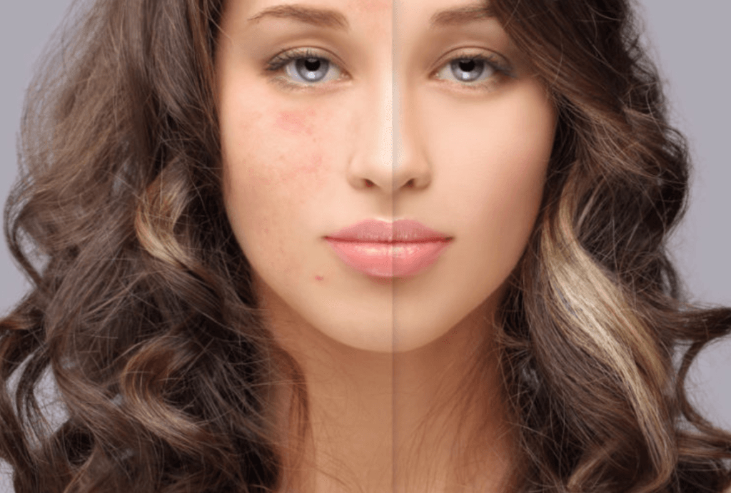 Pigmentasi | JPP Skin Laser Clinic