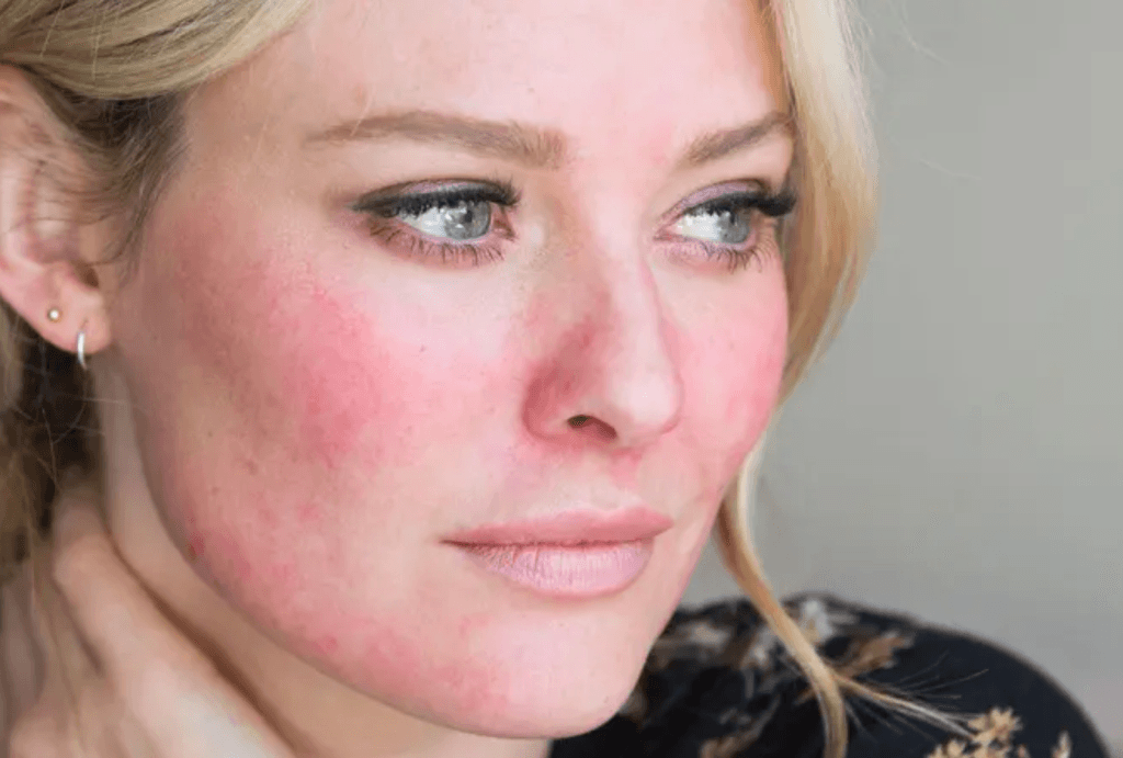 Rosacea | JPP Skin Laser Clinic