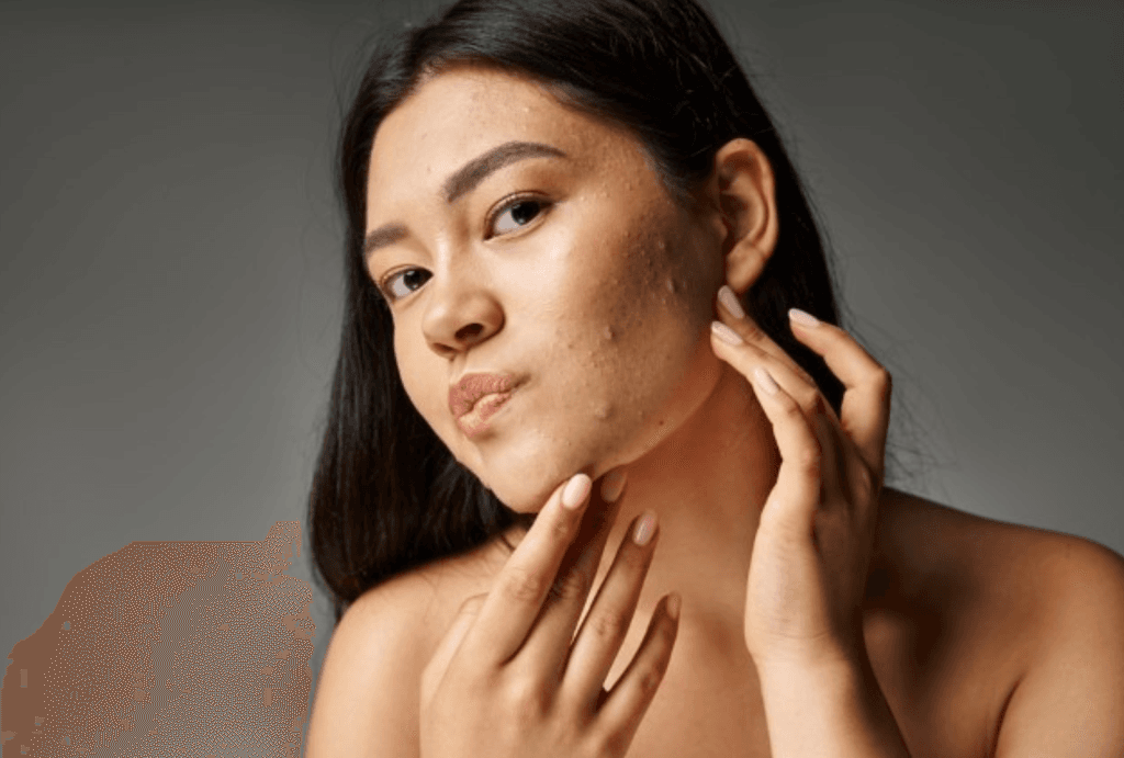 acne prone skin | JPP