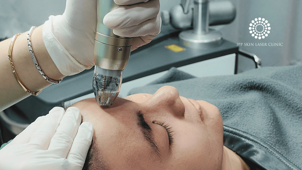 Radio Frequency | JPP Skin Laser Clinic