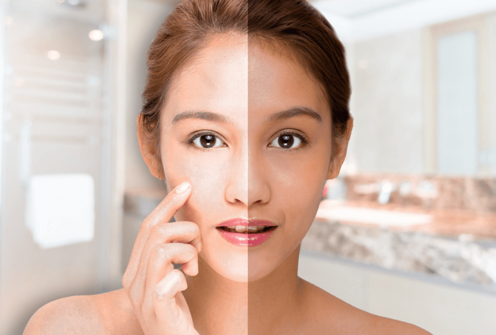 Kulit Belang | JPP Skin Laser Clinic