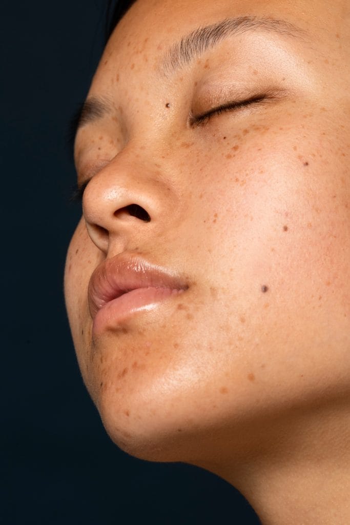 melasma
