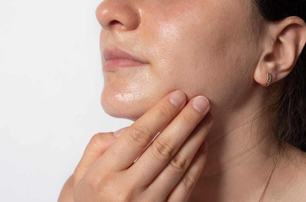 kulit berjerawat yang berminyak