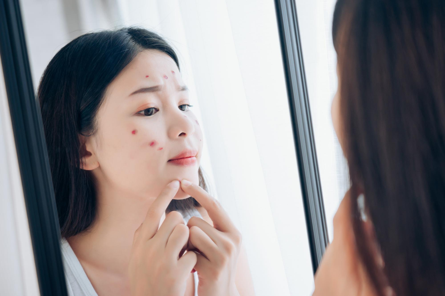 Jerawat Saat Haid: Penyebab, Pencegahan, dan Cara Mengatasinya