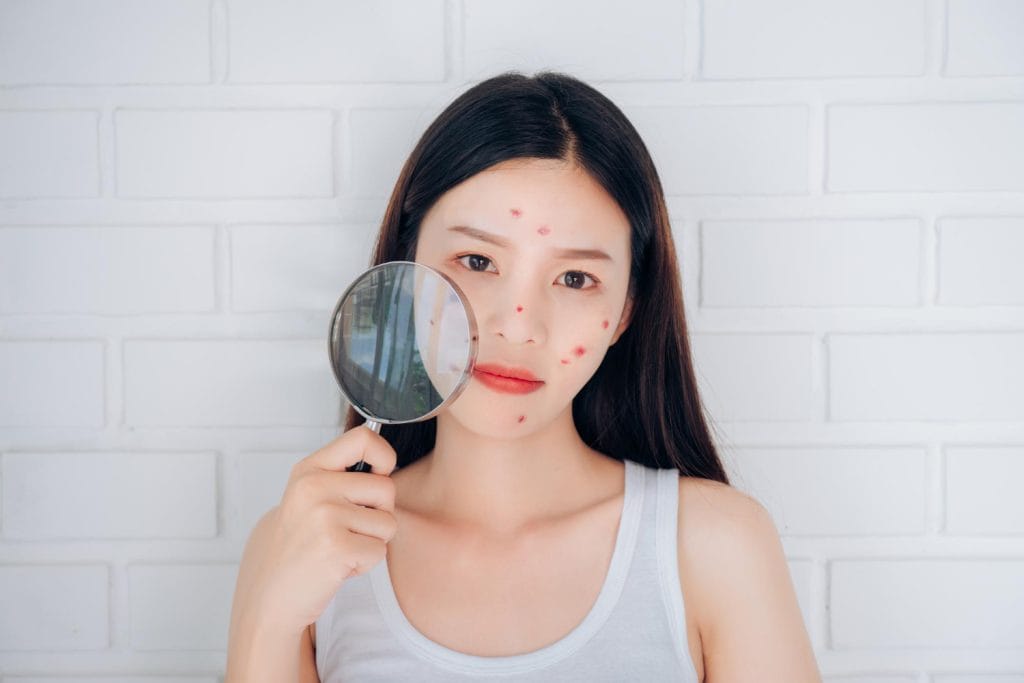 acne mapping