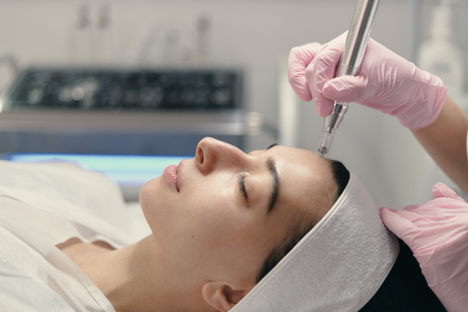 Bekas Jerawat: Lebih Baik Laser atau Microneedling?