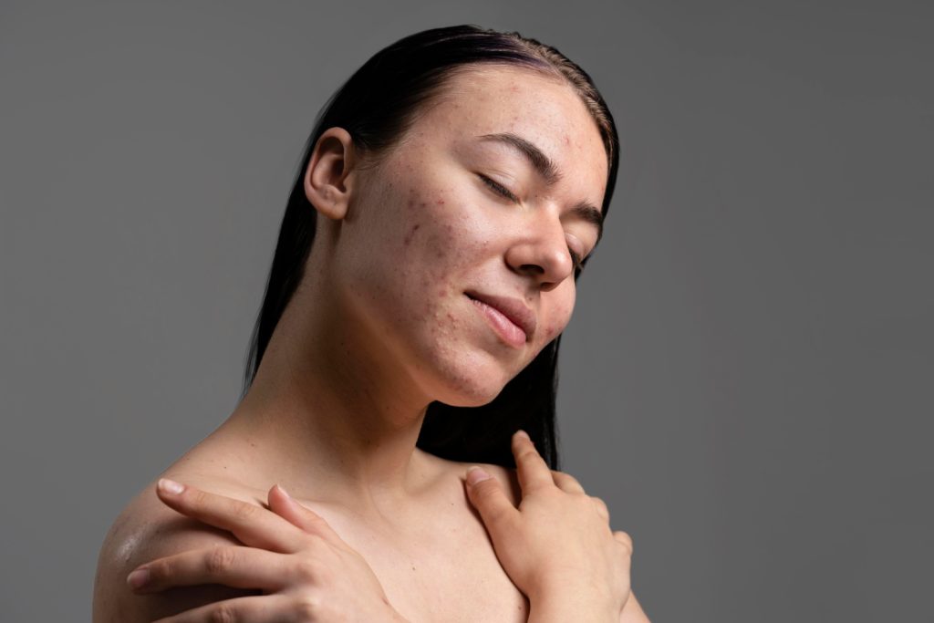 fungal acne