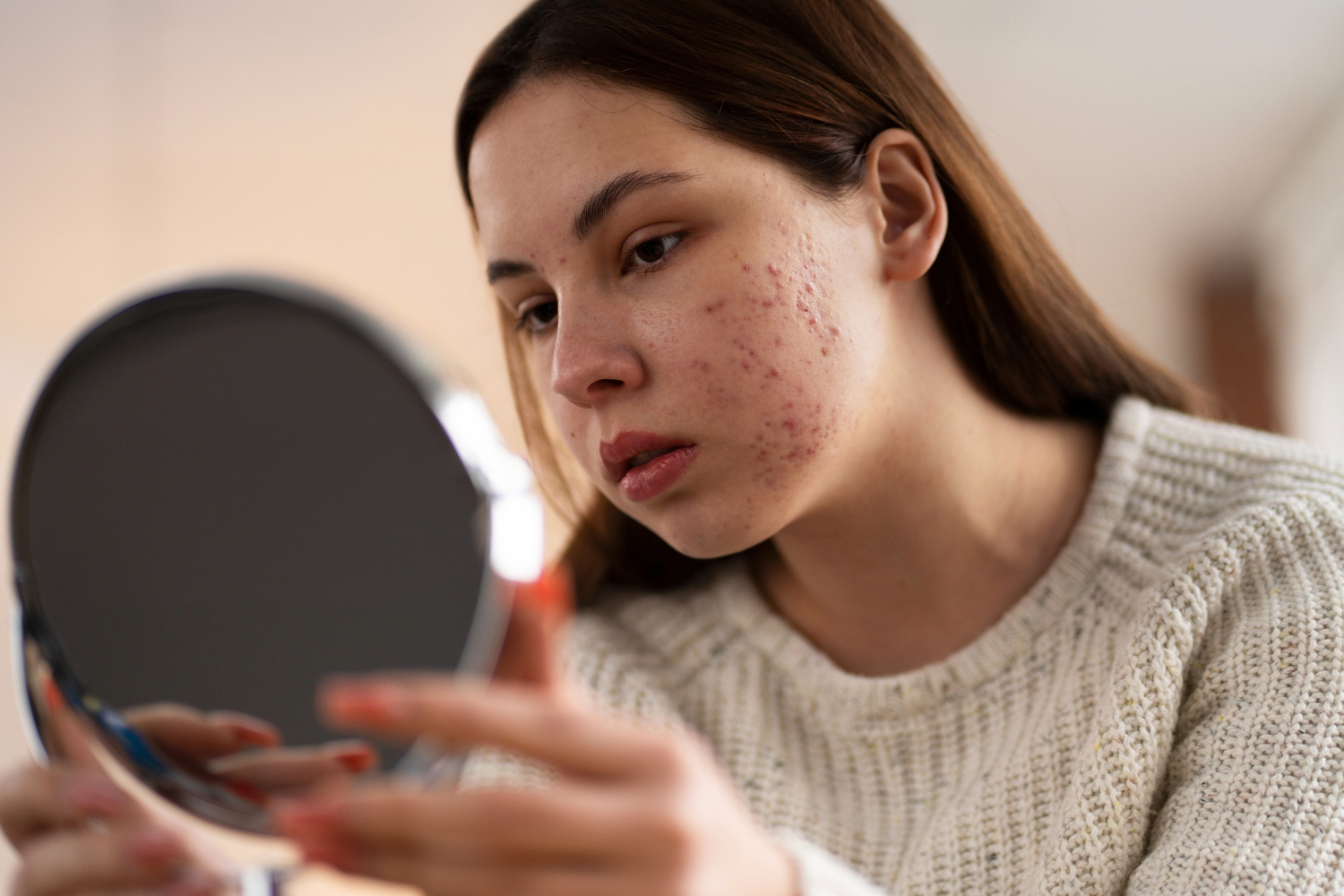 Fungal Acne, Penyebab dan Perbedaannya dengan Jerawat Biasa