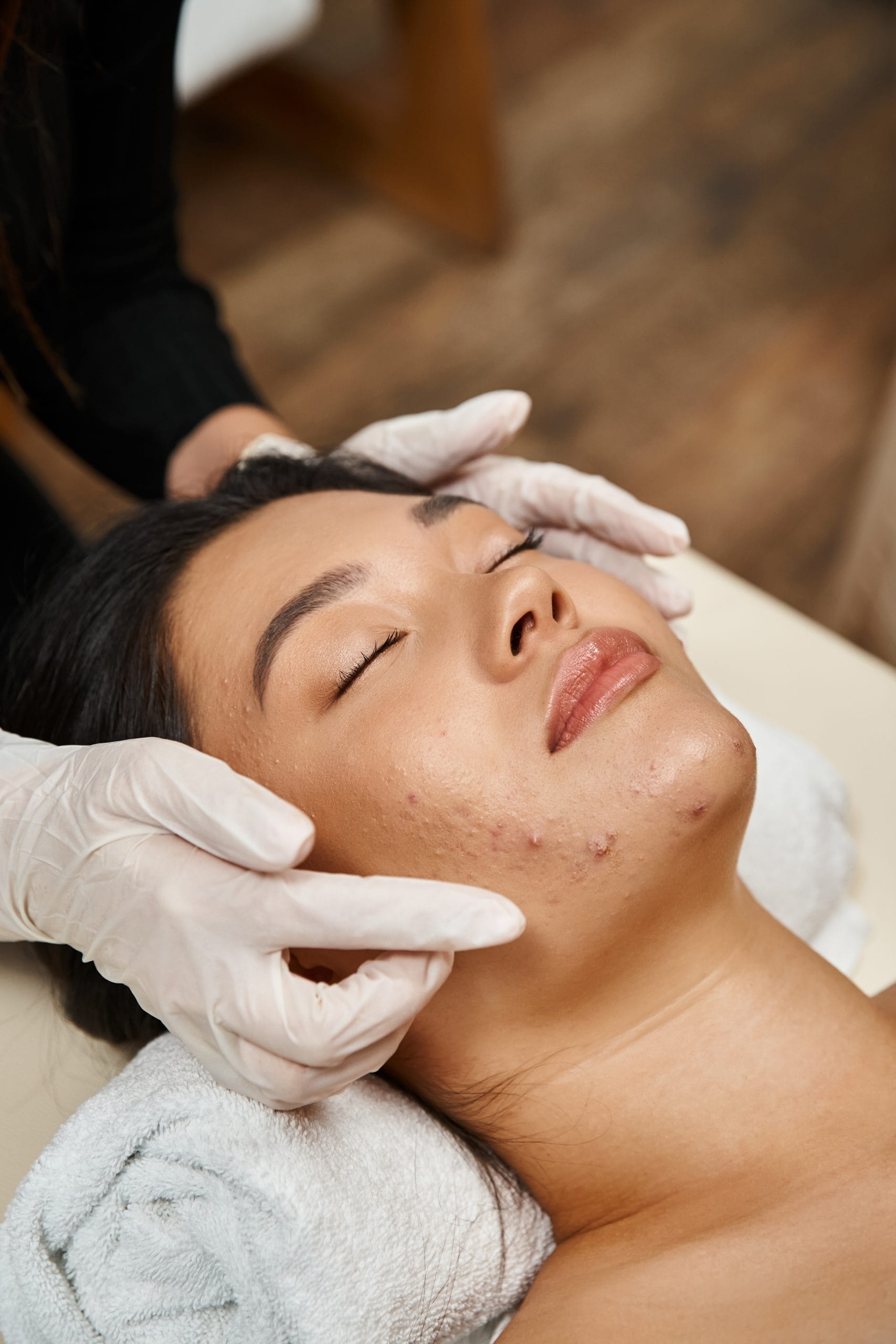 Treatment Jerawat & Bekas Jerawat JPP Clinic